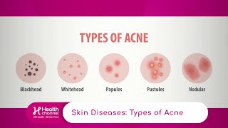 Types of Acne [upl. by Fogarty]