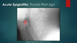 Acute Epiglottitis Thumb Sign [upl. by Mortensen]