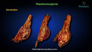 Behind the Mystery Understanding Pheochromocytoma and Paraganglioma [upl. by Einnep]