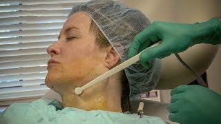 Technique for Lower Face and Neck Tightening With FaceTite [upl. by Llerej54]