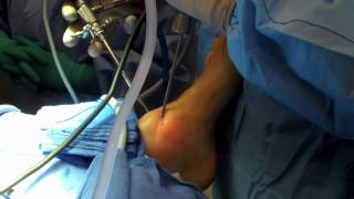 Ankle Arthroscopy [upl. by Palladin]