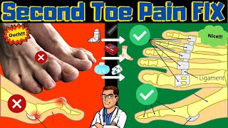 Second Toe Pain TREATMENT Capsulitis Taping amp Freiberg Disease FIX [upl. by Iknarf528]