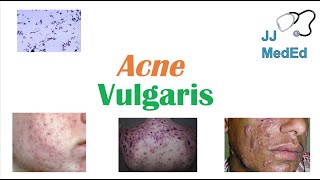 Acne Vulgaris  Causes Pathogenesis Influencing Factors Diagnosis Treatment and Complications [upl. by Anehc761]