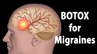 Migraine Treatment  Sumatriptan Succinate Injection  Imatrex [upl. by Rowney]