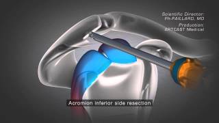 Arthroscopic Double Pulley Remplissage Technique [upl. by Niles]