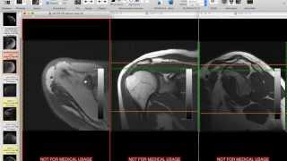 Systematic Interpretation of Shoulder MRI How I do it [upl. by Chance103]