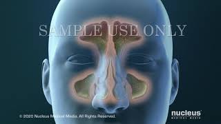 Sinusitis Surgery [upl. by Marlon]