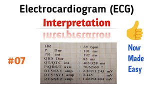 EKGECG QT Interval  ECG Question 200  The EKG Guy [upl. by Stubbs950]