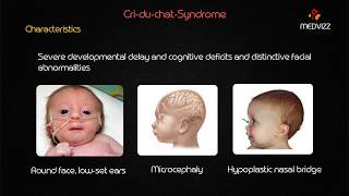 CriduChat Syndrome  Usmle step 1 lecture [upl. by Adin]