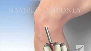 Knee Arthroscopy [upl. by Anrym]