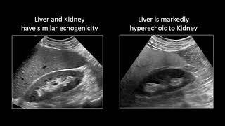 GI Imaging  Hepatic Steatosis and Cirrhosis [upl. by Bang254]