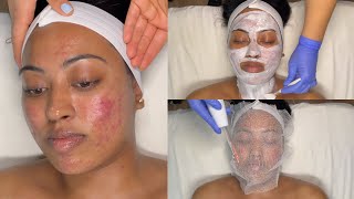 CYSTIC ACNE TREATMENT  WALKIN FACIAL FOR GRADE 3 AND 4 ACNE WITH PRO TIPS  LICENSED ESTHETICIAN [upl. by Cicily]