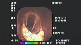 Epiglottic Entrapment [upl. by Kathleen]