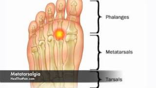 Metatarsalgia Foot Pain Causes Symptoms amp Treatments [upl. by Engelhart]