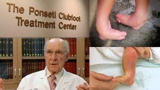 CLUB FOOT Pathoanatomy Made Easy  The Young Orthopod [upl. by Atter819]