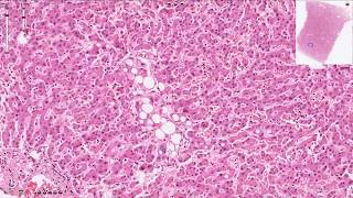 Hepatic Steatosis  Histopathology  Normal Liver Histology [upl. by Aray]