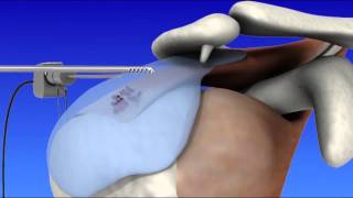 Shoulder Arthroscopy [upl. by Netram]