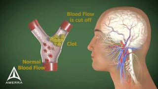 Stroke  3D Medical Animation [upl. by Amory]