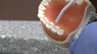 New cavity treatment offers no drilling no filling [upl. by Leohcin970]