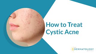 How to Treat Cystic Acne [upl. by Atived]