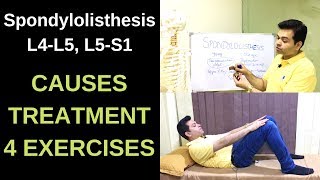 Spondylolisthesis 4 Exercises to Reduce Pain Demo on Real Patient [upl. by Rubel557]